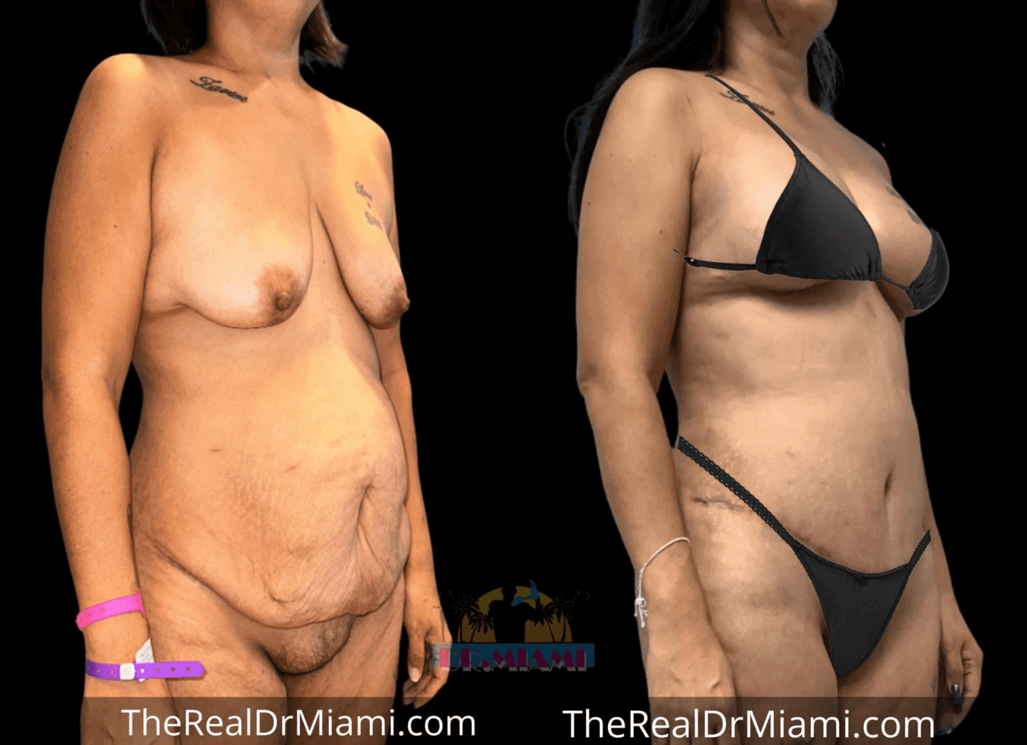 Before-and-after views for Mommy Makeover, Case 43.