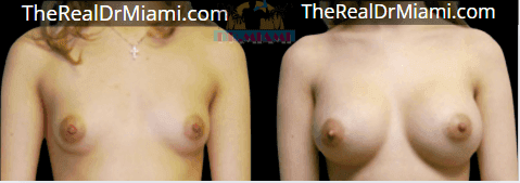 Before-and-after views for Breast Augmentation, Case 96.