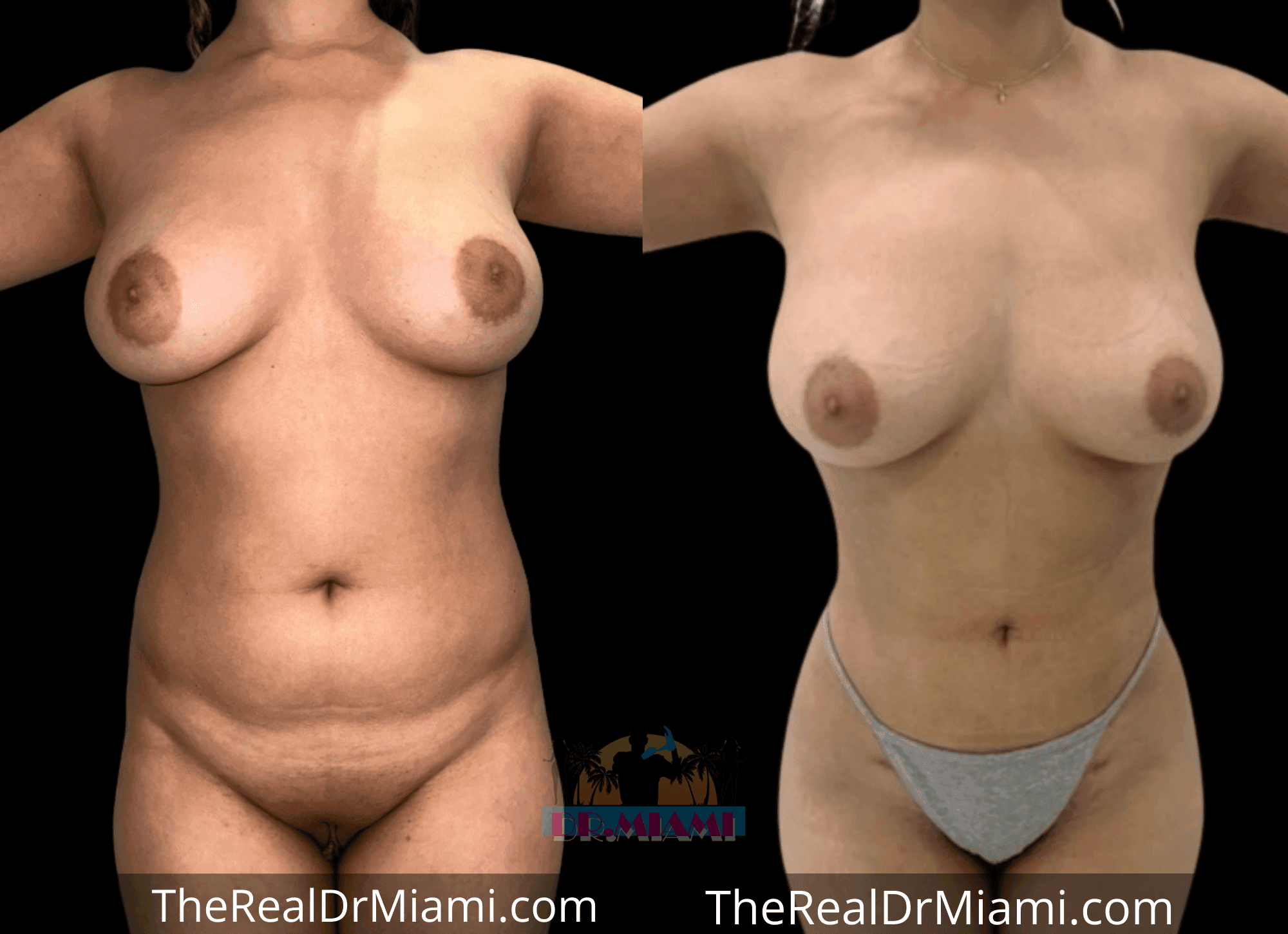 Before-and-after views for Brazilian Butt Lift, Case 122.
