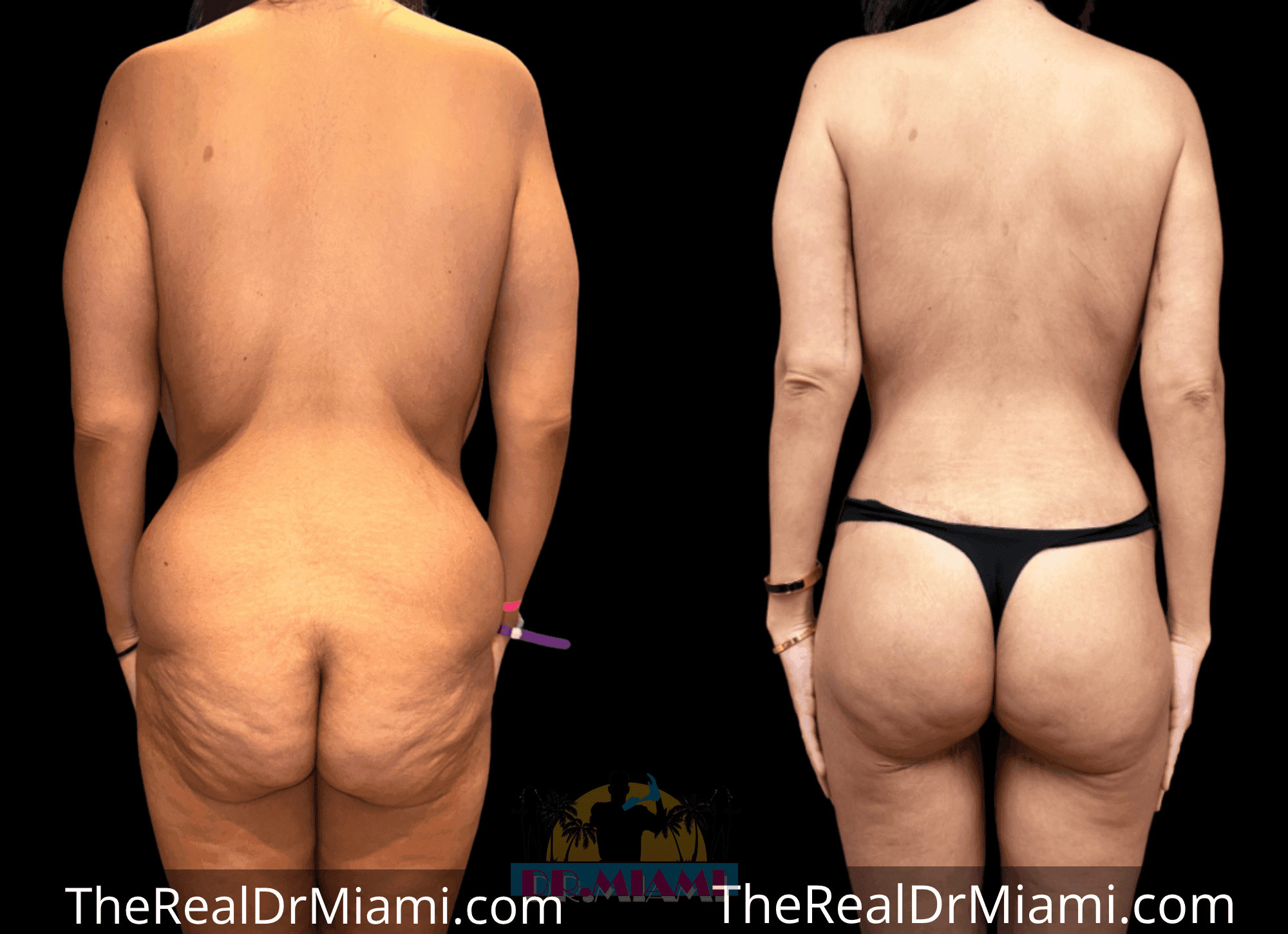 Before-and-after views for Massive Weight Loss, Case 11.
