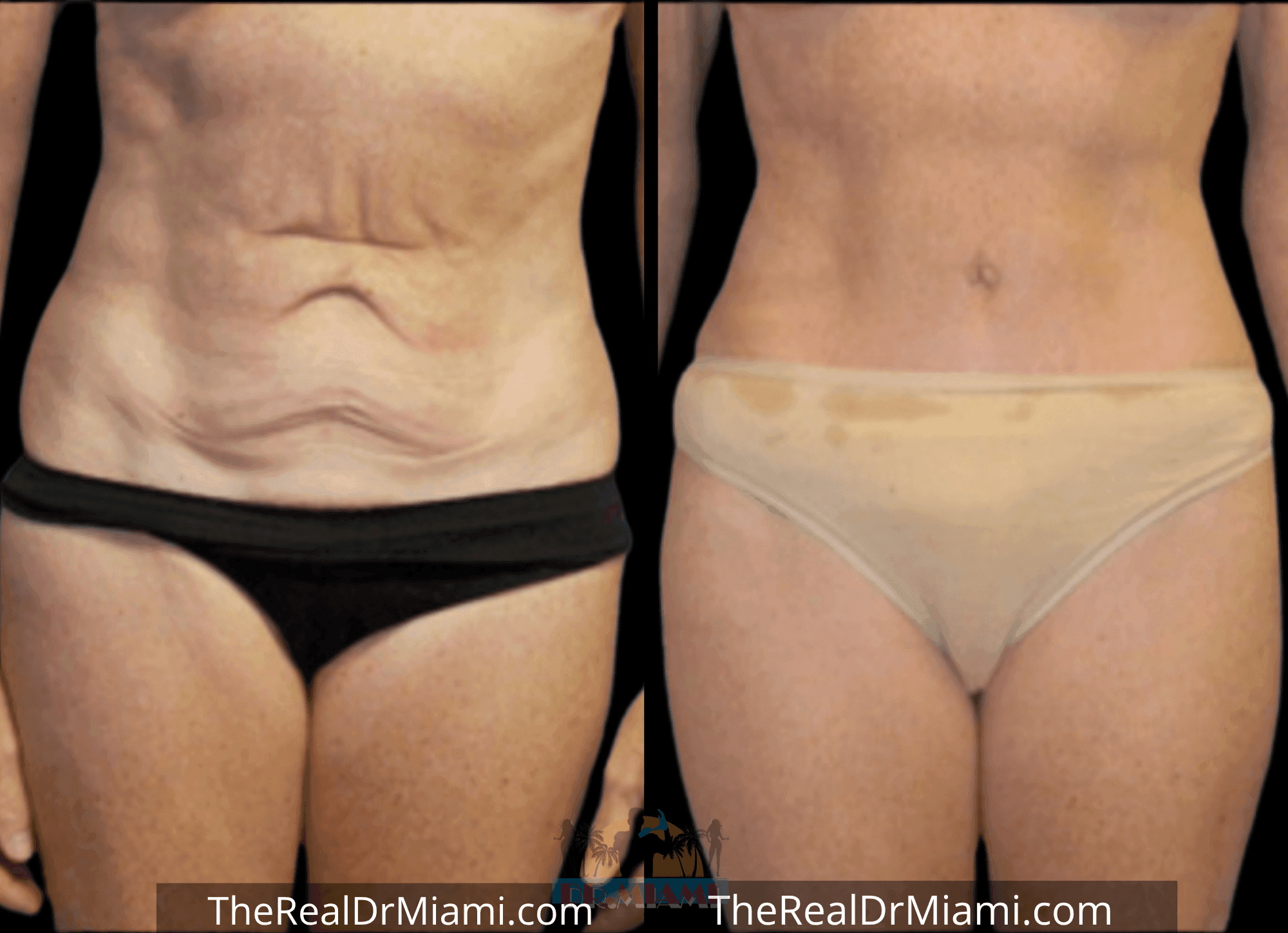 Before-and-after views for Tummy Tuck, Case 71.