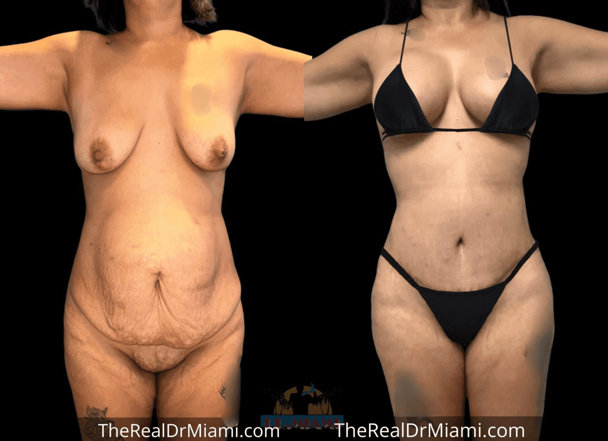 Before-and-after views for Mommy Makeover, Case 26.