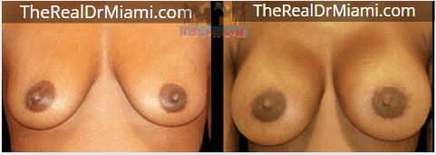 Before-and-after views for Breast Augmentation, Case 113.