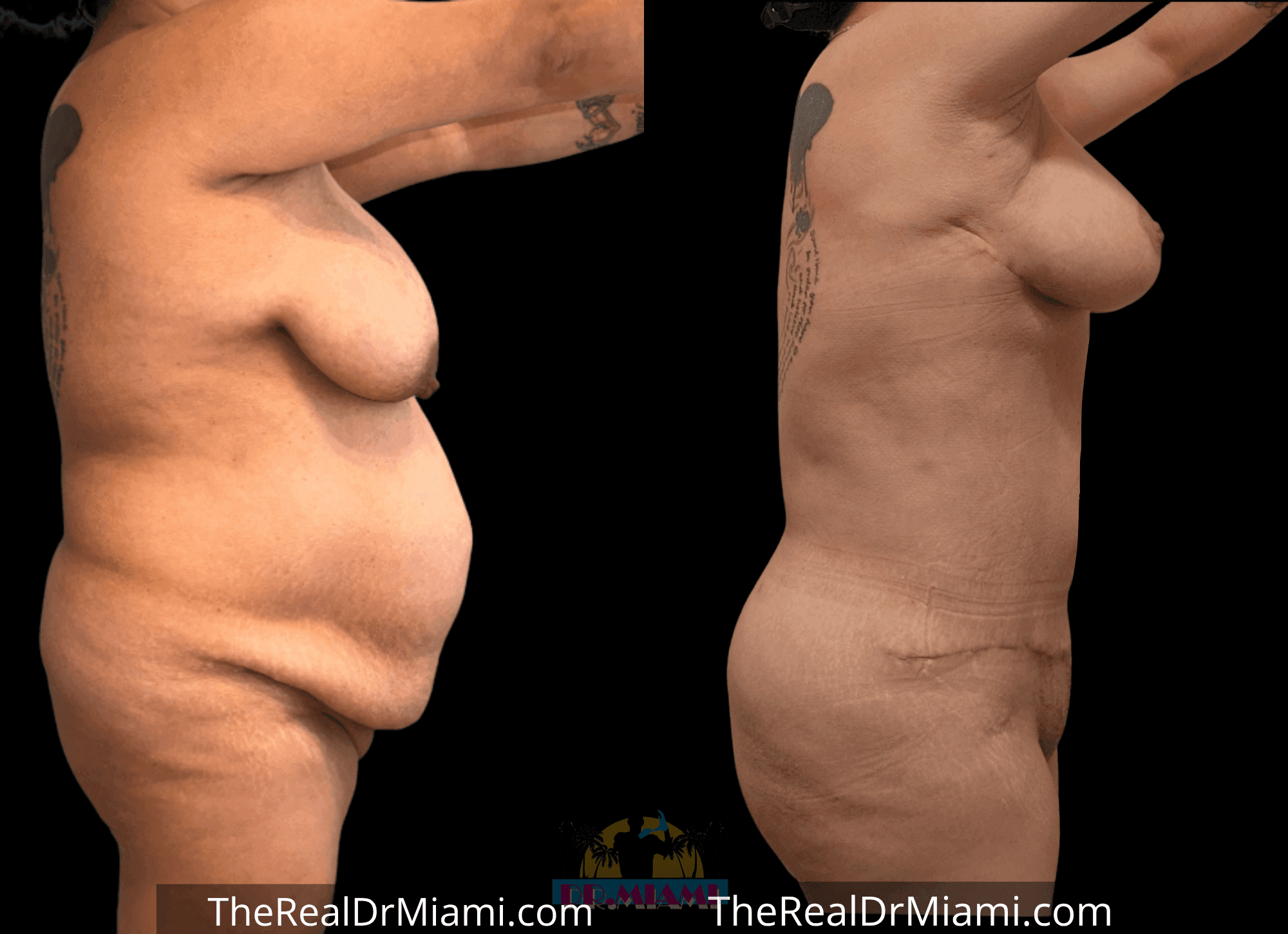 Before-and-after views for Tummy Tuck, Case 29.