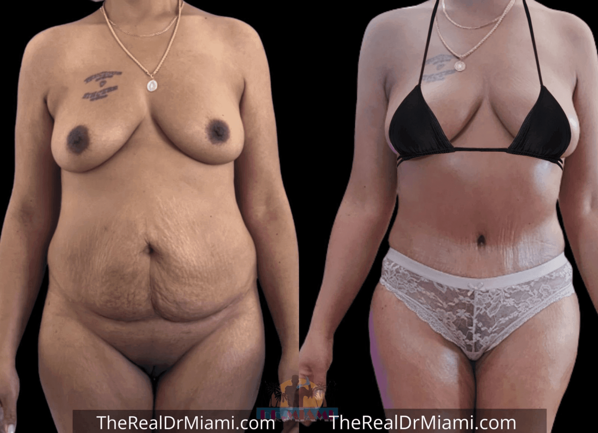 Before-and-after views for Tummy Tuck, Case 41.