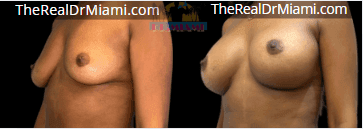Before-and-after views for Breast Augmentation, Case 47.