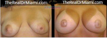 Before-and-after views for Breast Augmentation, Case 23.
