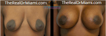 Before-and-after views for Breast Augmentation, Case 27.