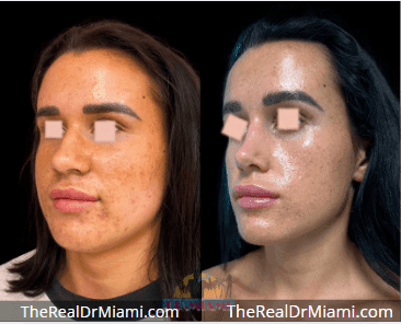 Before-and-after views for Rhinoplasty, Case 113.