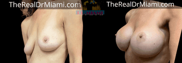 Before-and-after views for Breast Augmentation, Case 72.