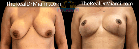 Before-and-after views for Breast Lift, Case 49.