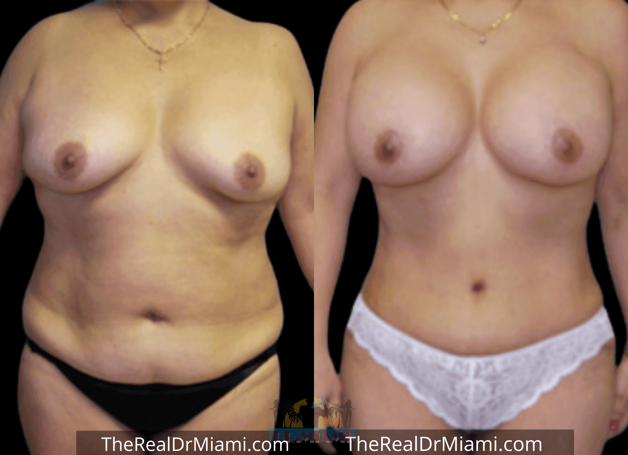 Before-and-after views for Tummy Tuck, Case 1.