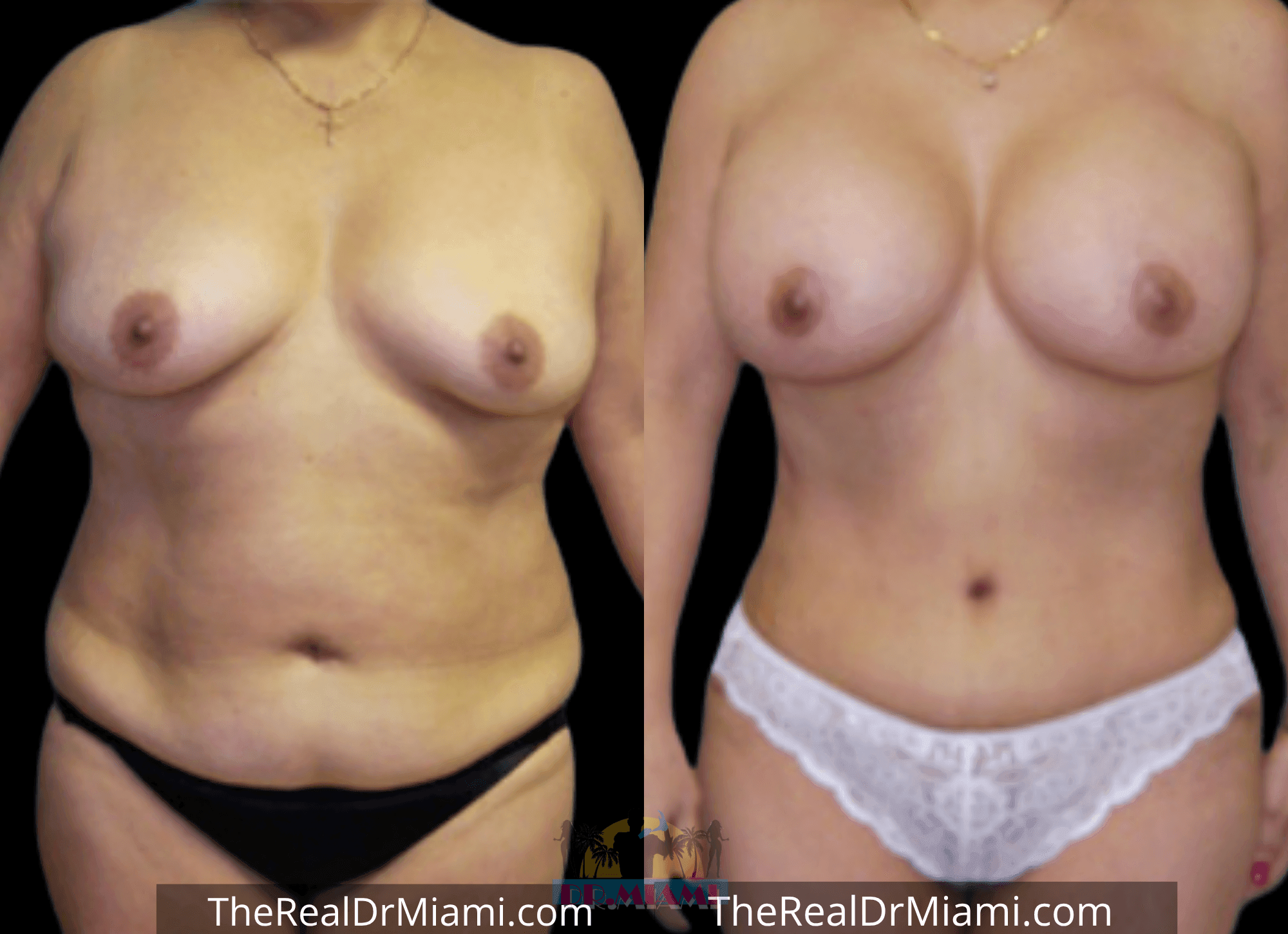 Before-and-after views for Tummy Tuck, Case 1.