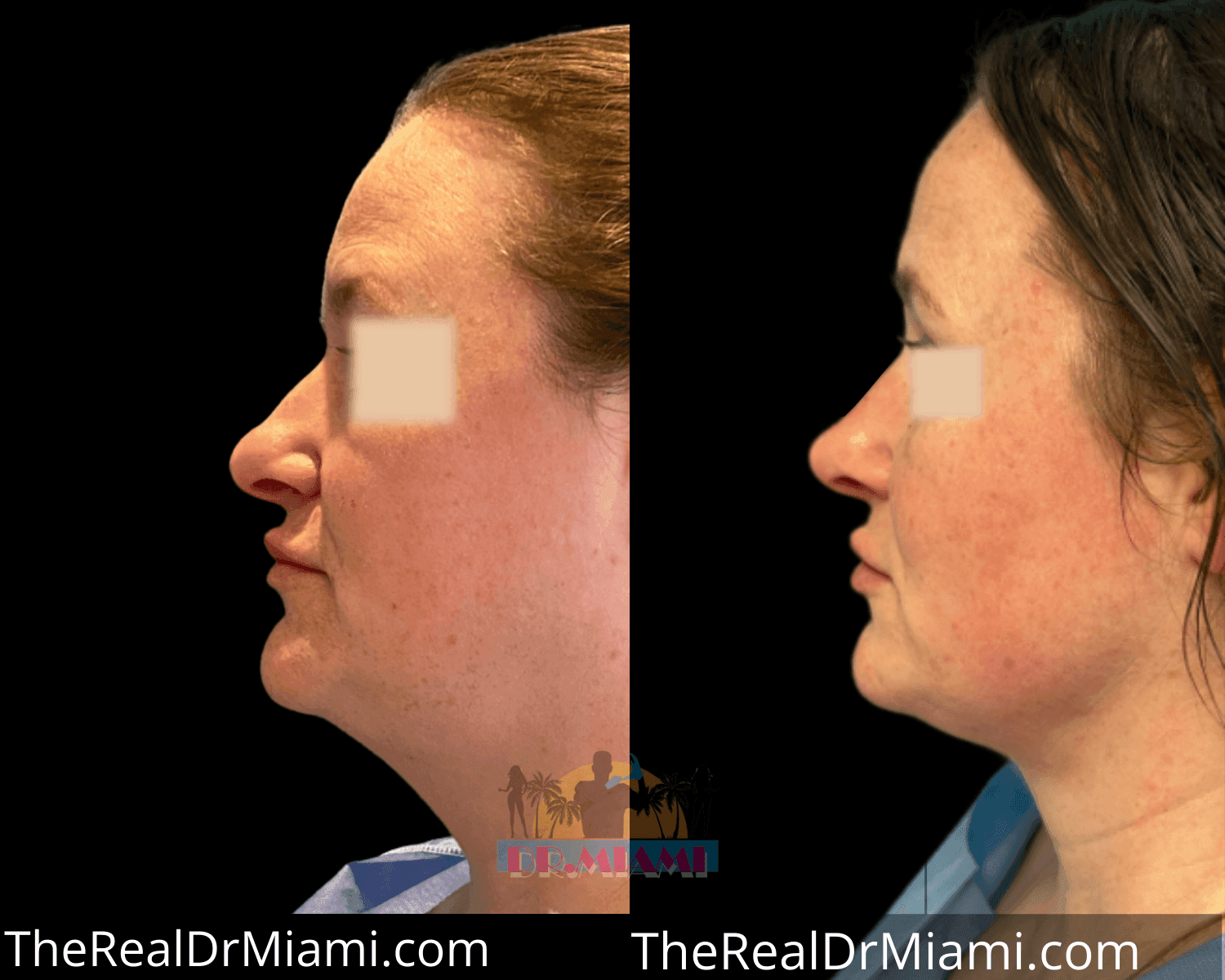Before-and-after views for Rhinoplasty, Case 49.