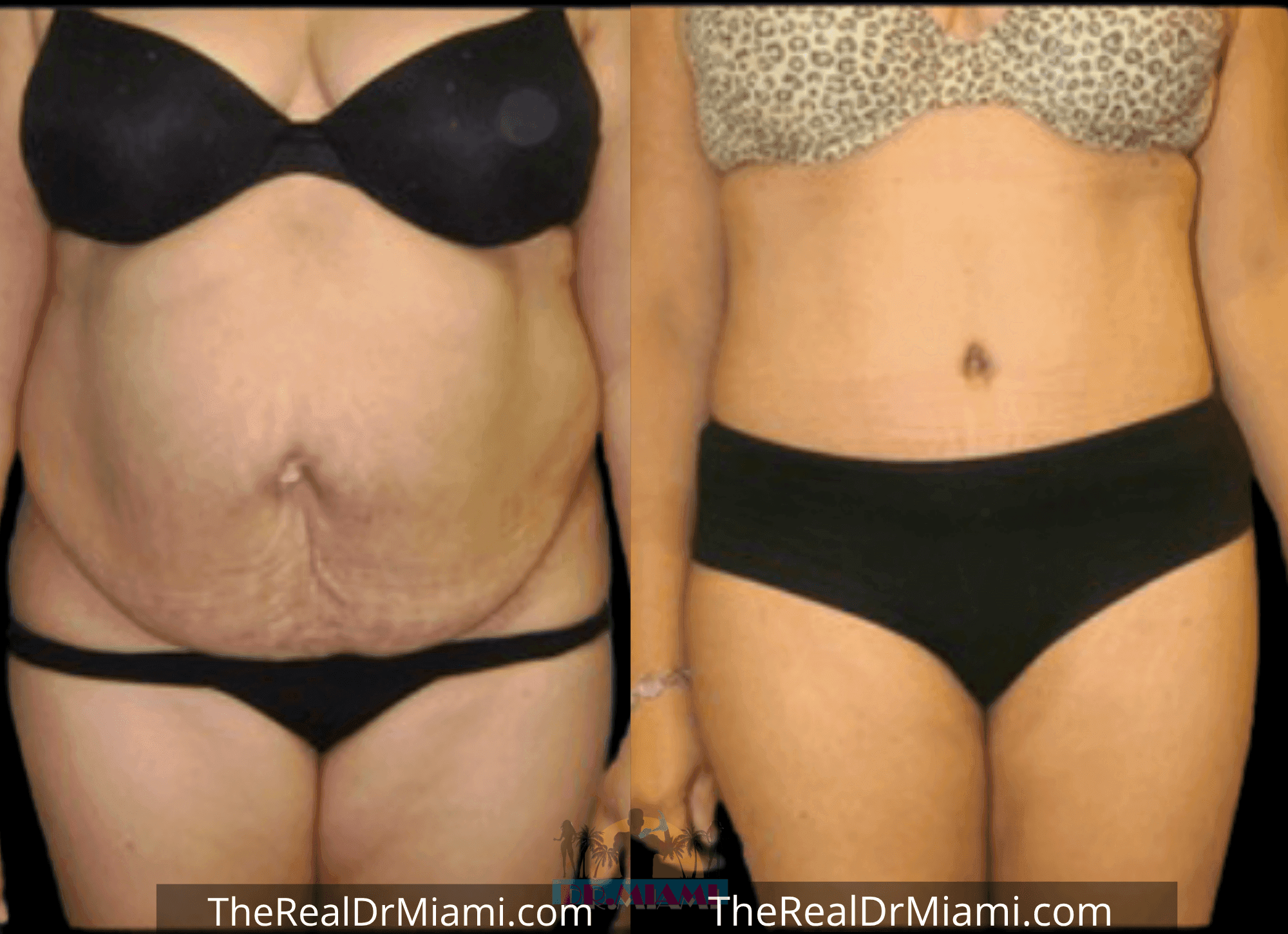 Before-and-after views for Tummy Tuck, Case 72.
