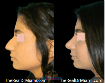 Before-and-after views for Rhinoplasty, Case 74.