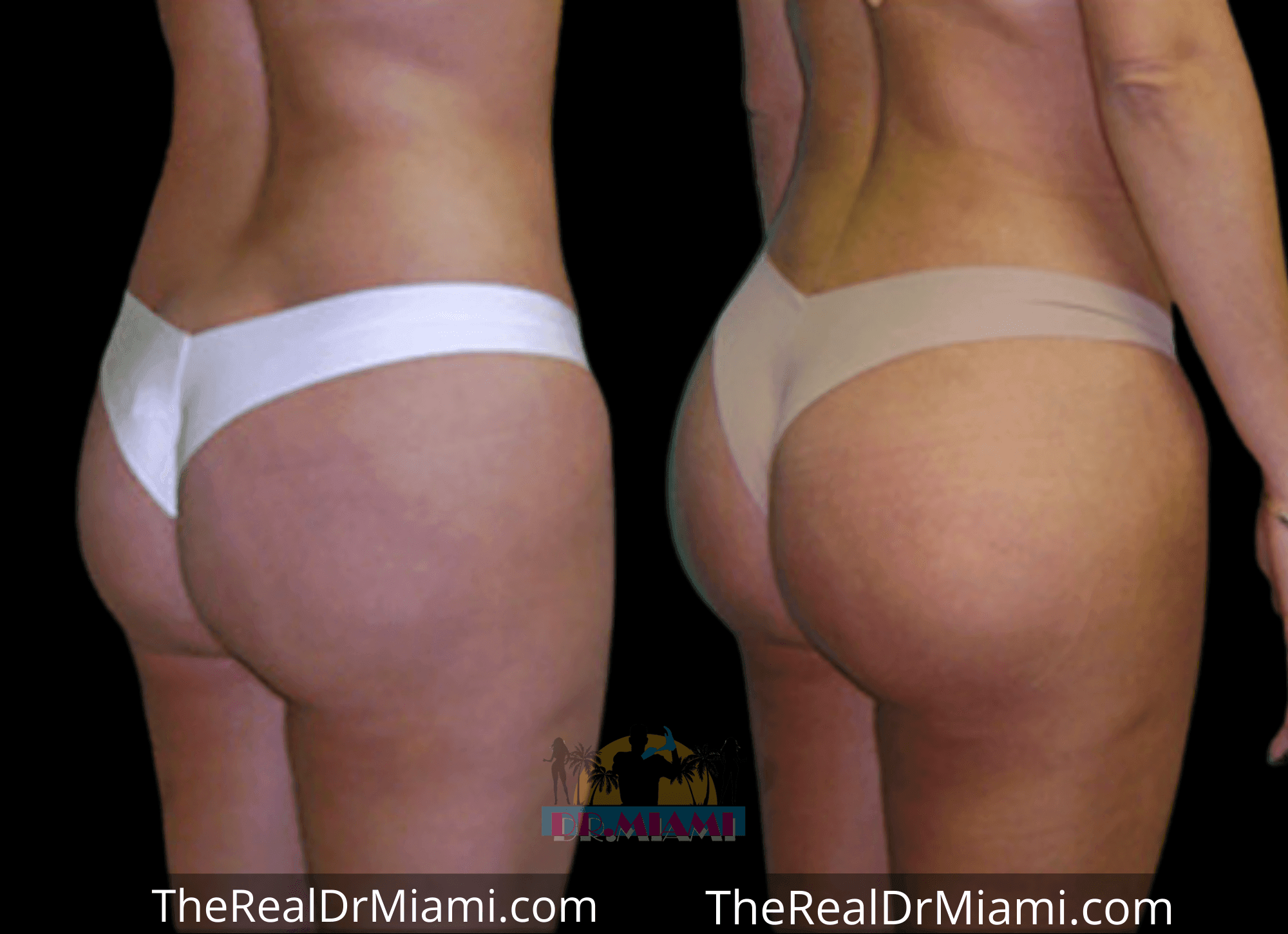 Before-and-after views for Brazilian Butt Lift, Case 12.