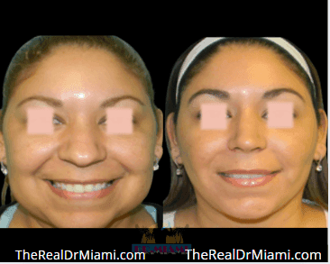 Before-and-after views for Rhinoplasty, Case 75.