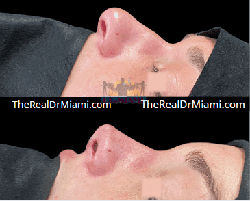 Before-and-after views for Rhinoplasty, Case 111.