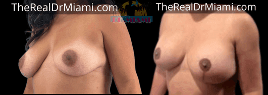 Before-and-after views for Breast Lift, Case 80.