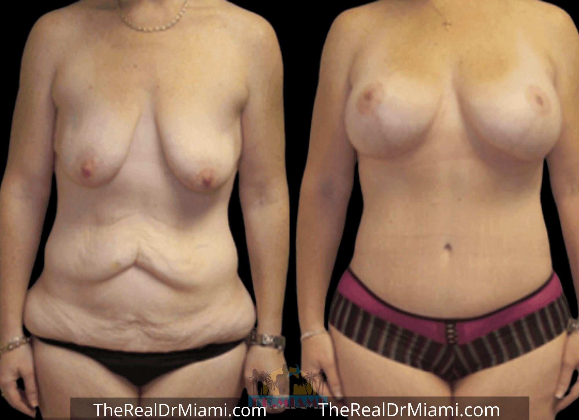 Before-and-after views for Mommy Makeover, Case 95.