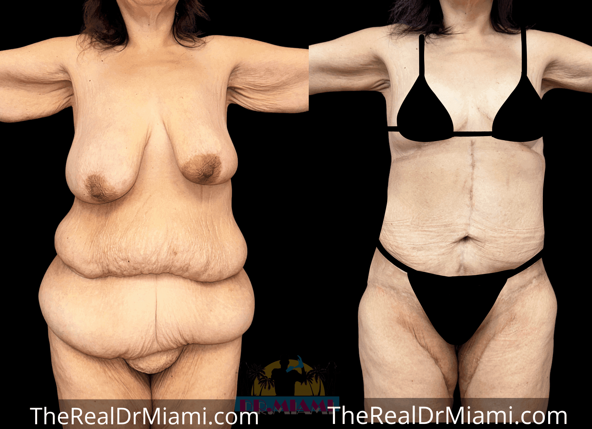 Before-and-after views for Massive Weight Loss, Case 2.