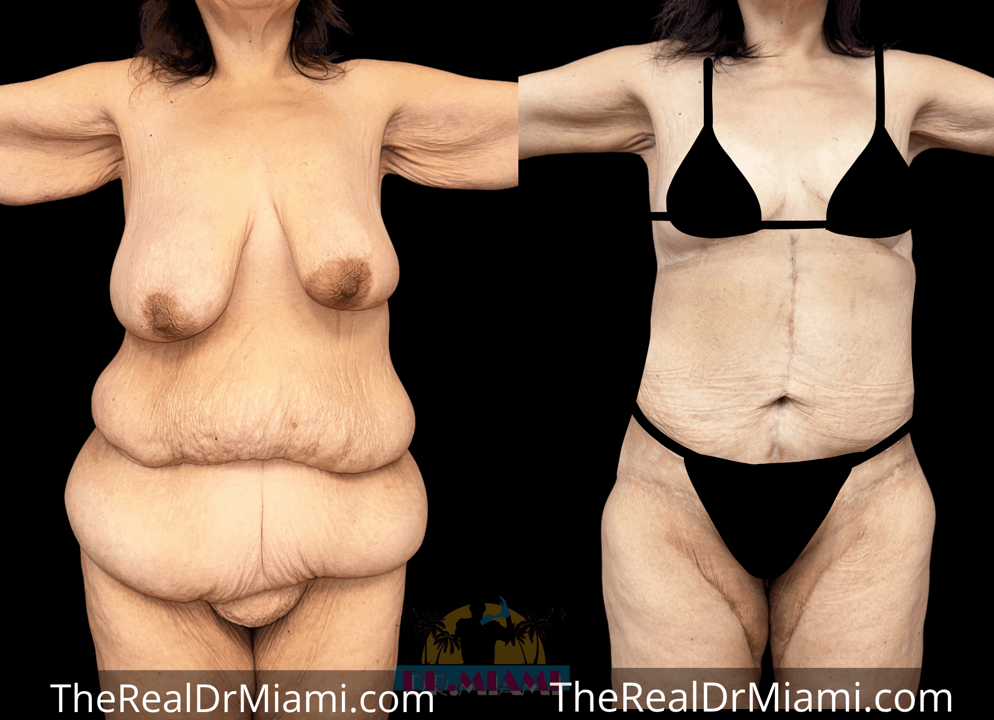 Before-and-after views for Massive Weight Loss, Case 2.