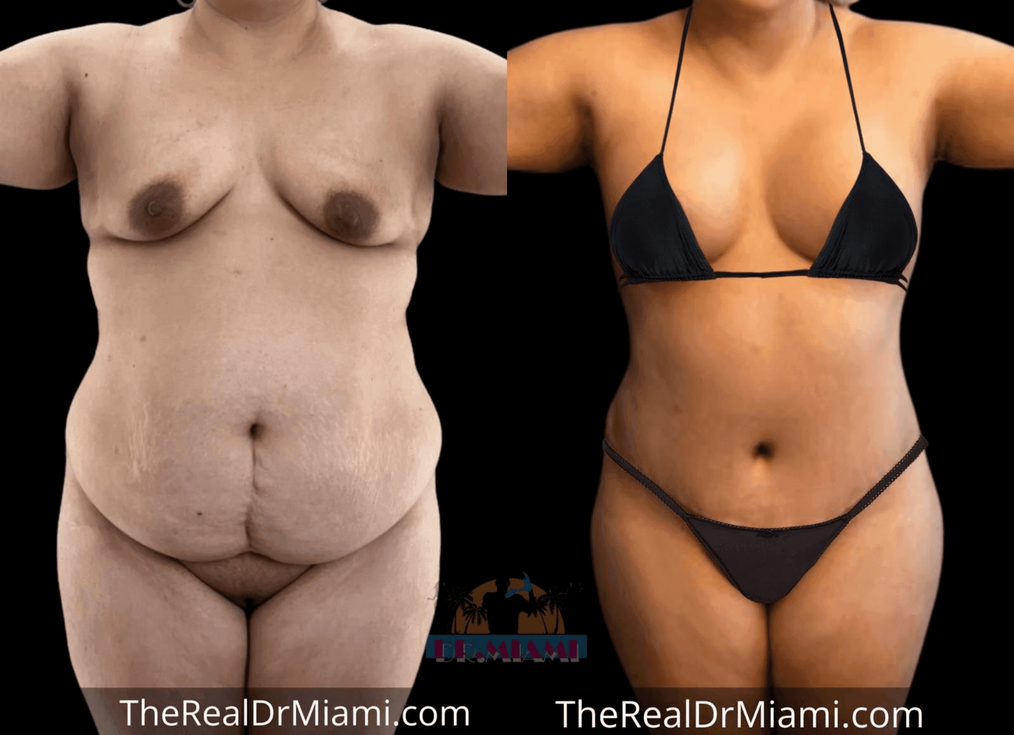 Before-and-after views for Mommy Makeover, Case 38.