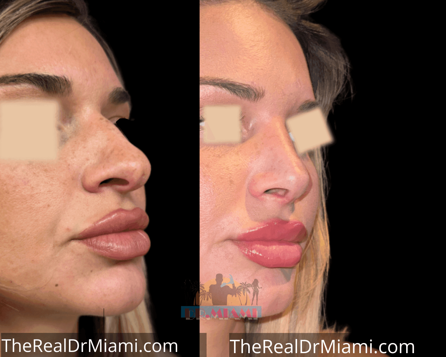 Before-and-after views for Rhinoplasty, Case 50.