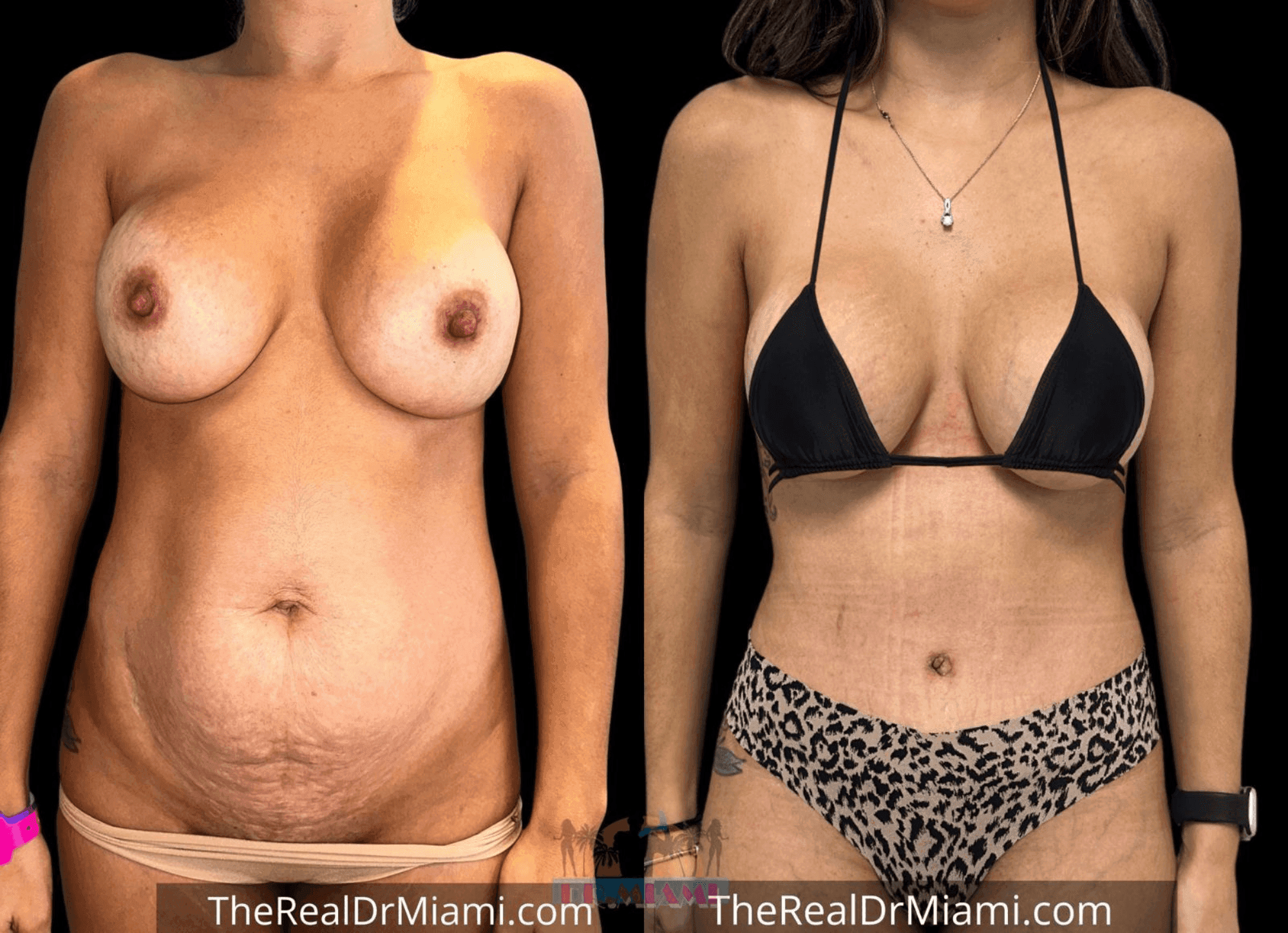 Before-and-after views for Tummy Tuck, Case 42.