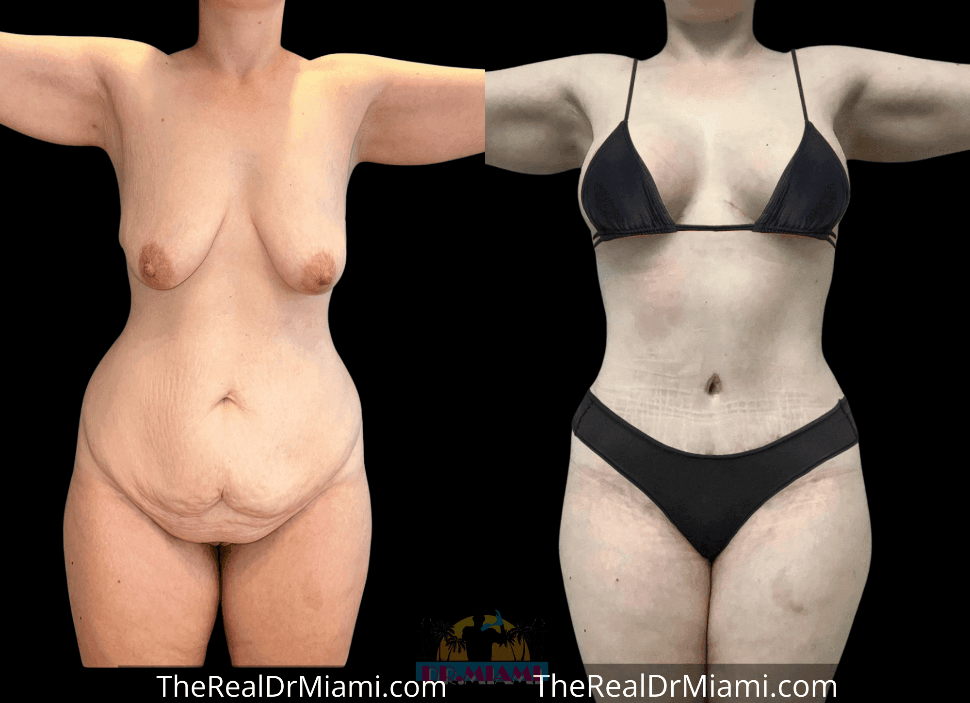 Before-and-after views for Mommy Makeover, Case 87.