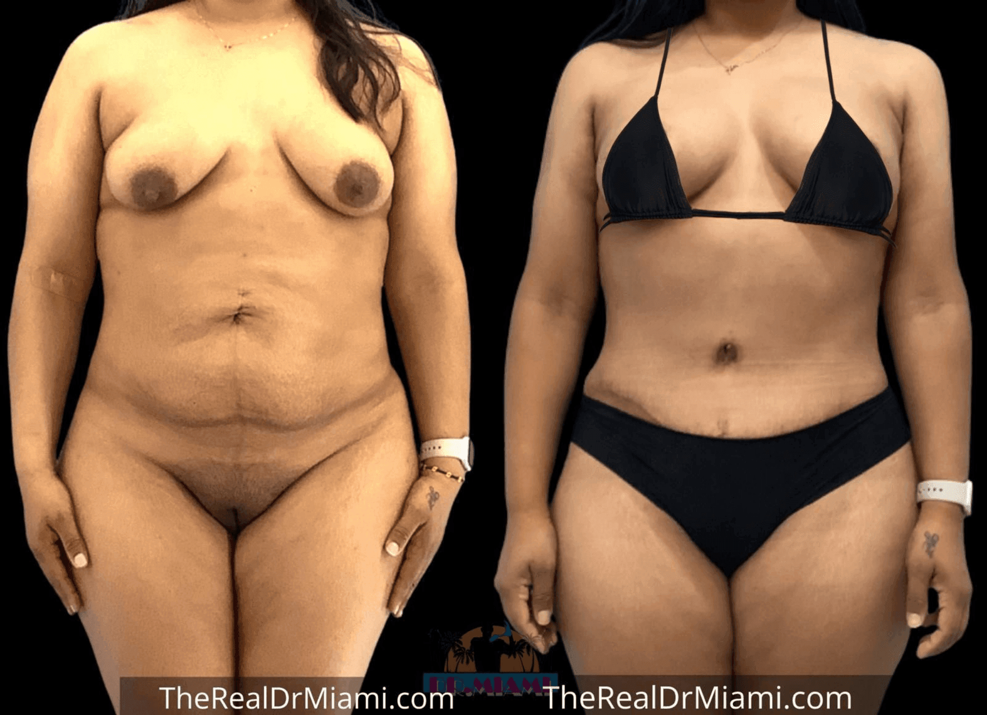 Before-and-after views for Mommy Makeover, Case 64.