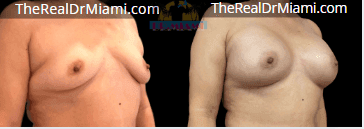 Before-and-after views for Breast Augmentation, Case 54.
