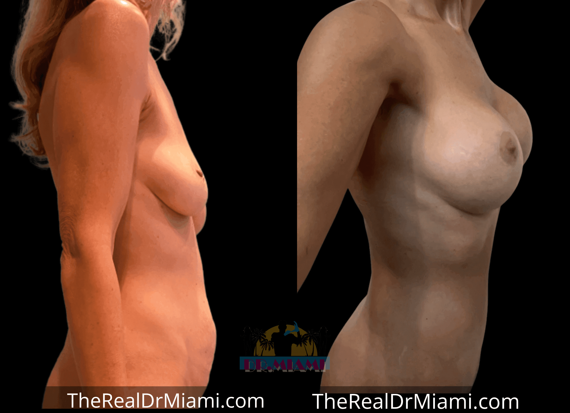 Before-and-after views for Mommy Makeover, Case 4.