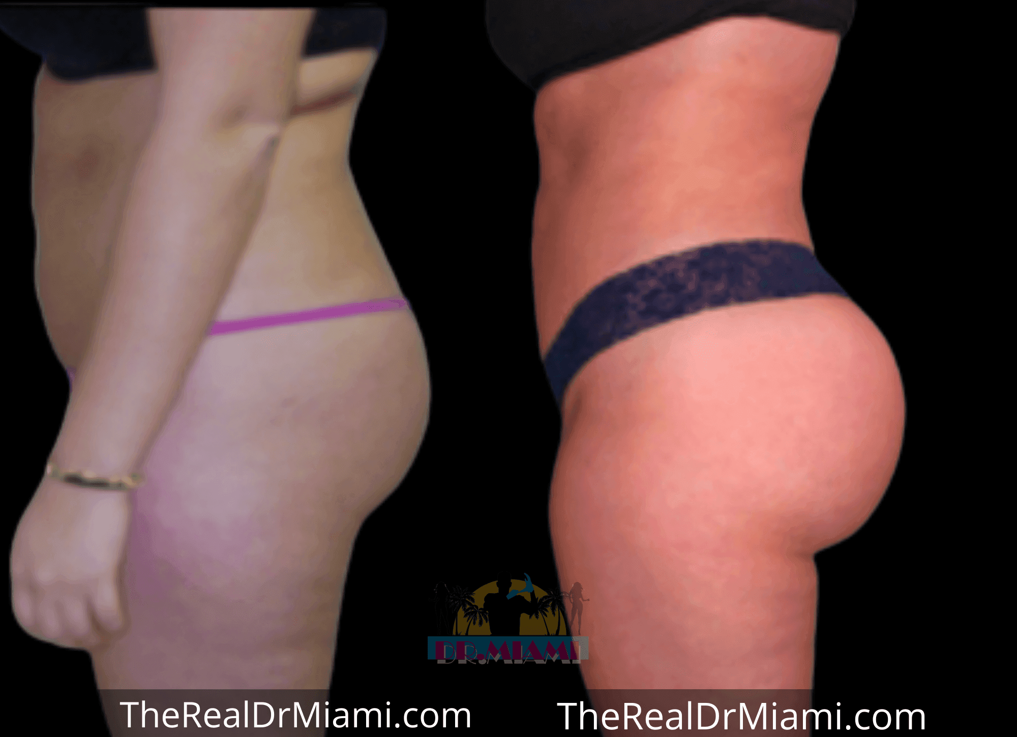 Before-and-after views for Brazilian Butt Lift, Case 74.