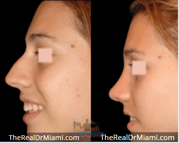 Before-and-after views for Rhinoplasty, Case 92.