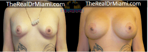 Before-and-after views for Breast Augmentation, Case 102.