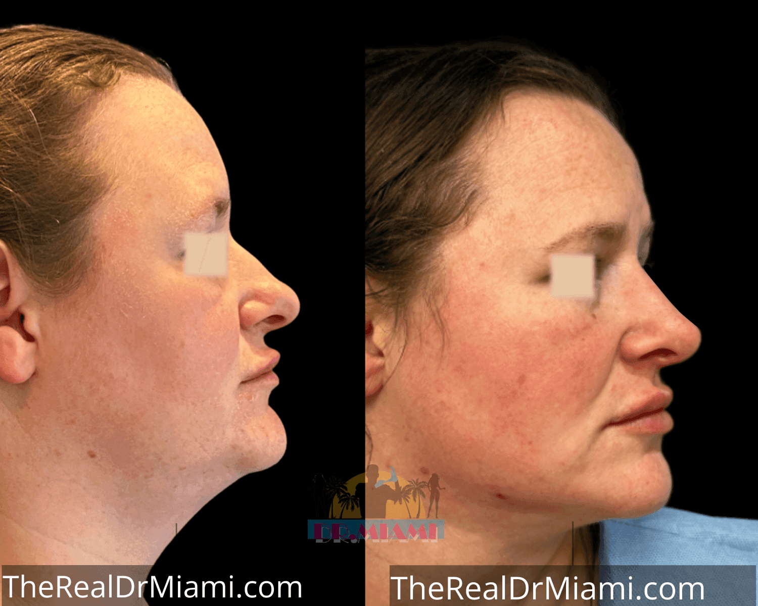 Before-and-after views for Rhinoplasty, Case 59.