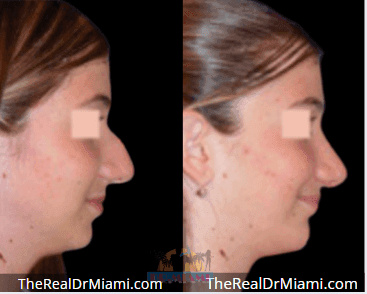 Before-and-after views for Rhinoplasty, Case 102.