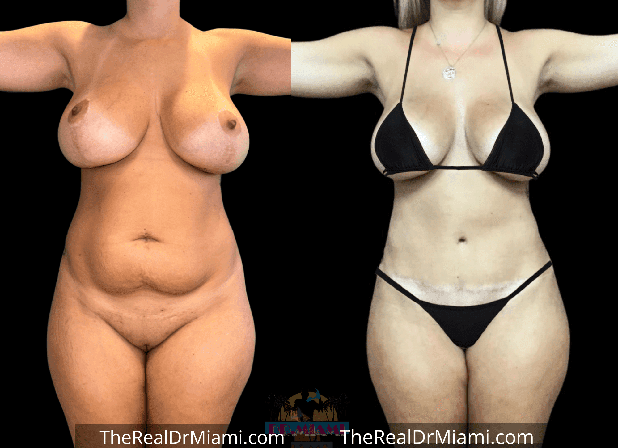 Before-and-after views for Tummy Tuck, Case 4.