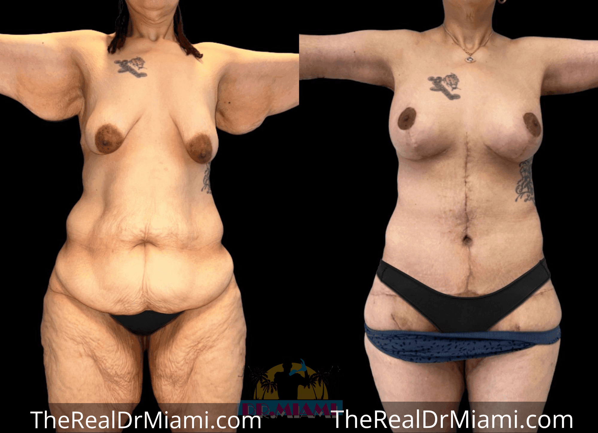 Before-and-after views for Massive Weight Loss, Case 6.