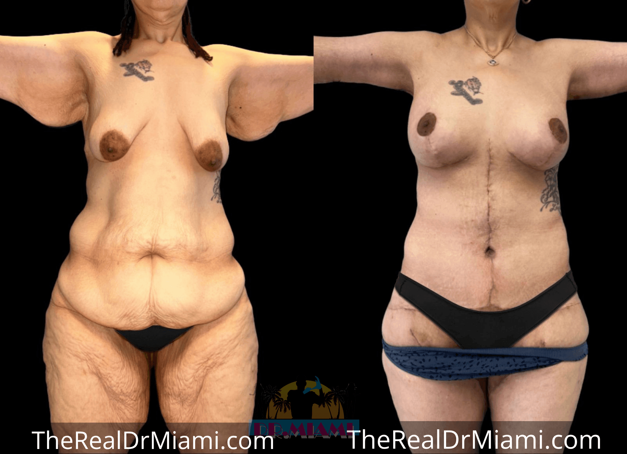 Before-and-after views for Massive Weight Loss, Case 6.