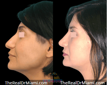 Before-and-after views for Rhinoplasty, Case 86.