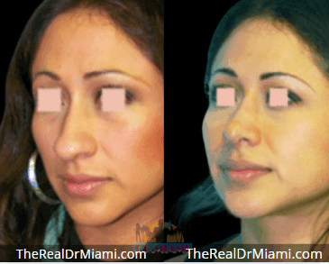 Before-and-after views for Rhinoplasty, Case 76.