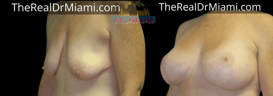 Before-and-after views for Breast Lift, Case 5.