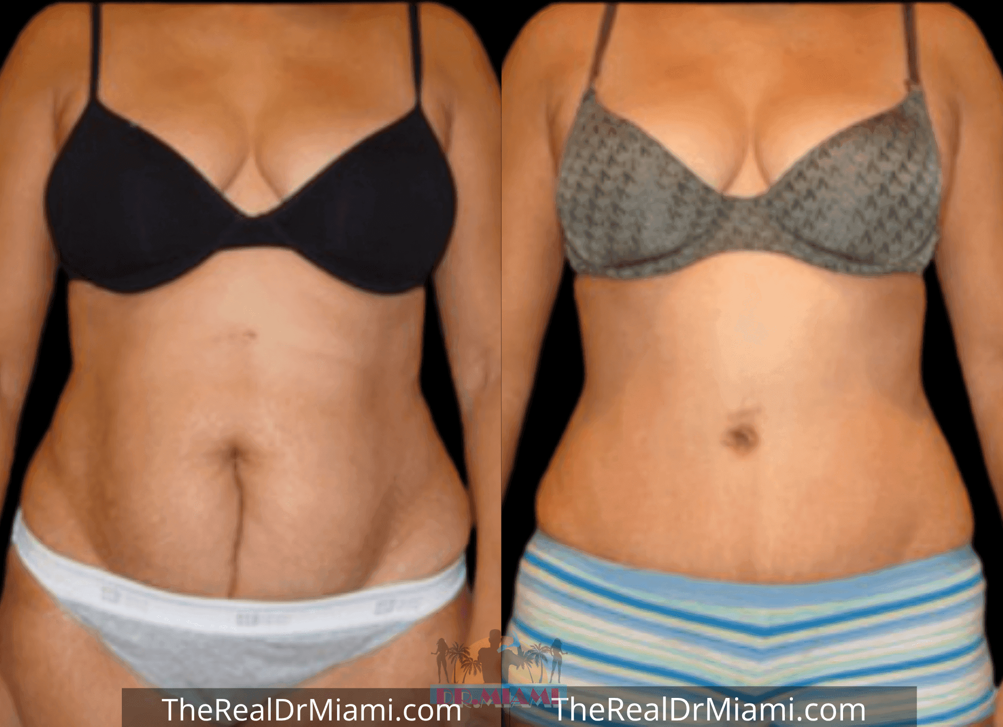 Before-and-after views for Tummy Tuck, Case 94.