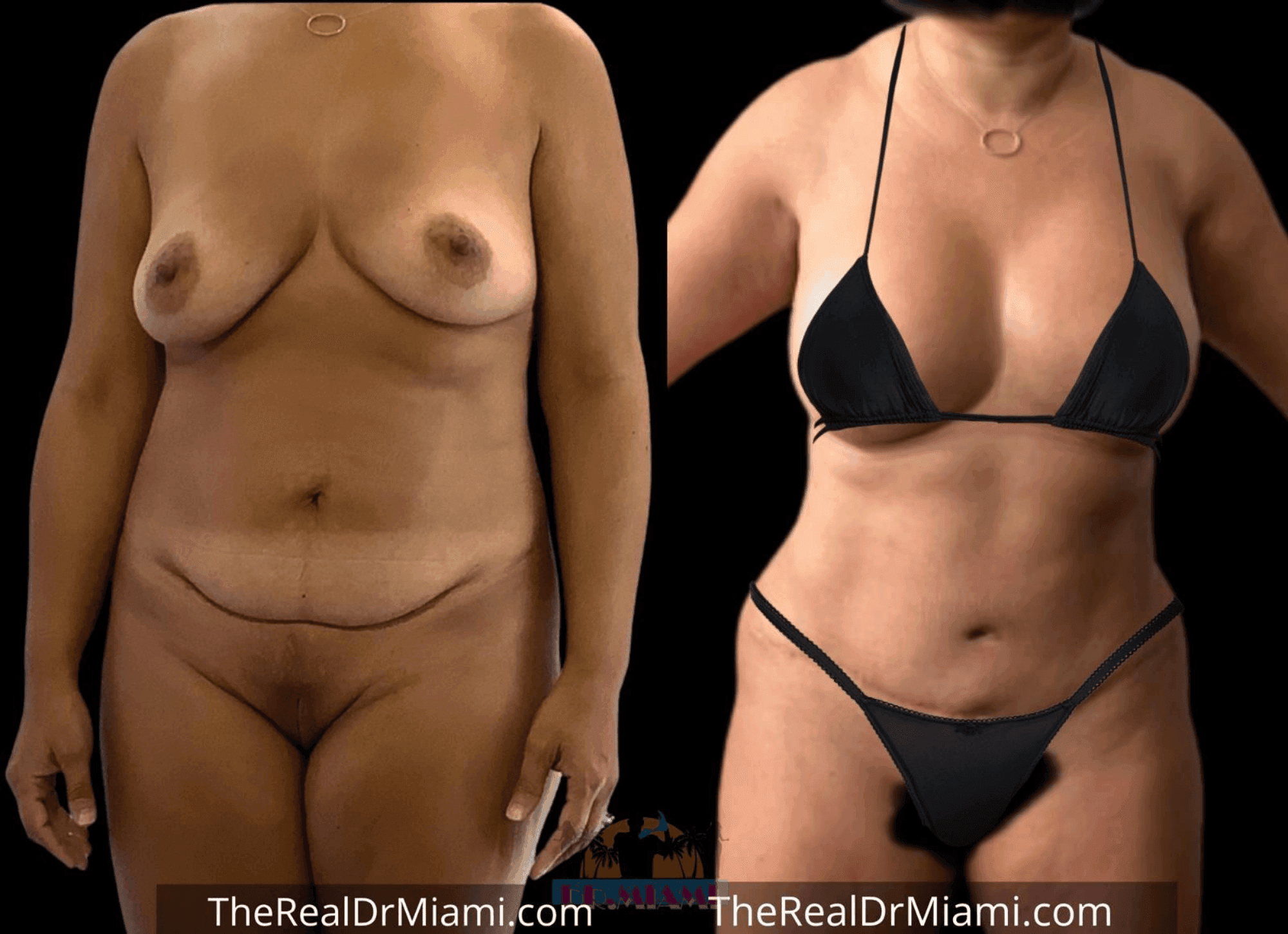 Before-and-after views for Mommy Makeover, Case 49.