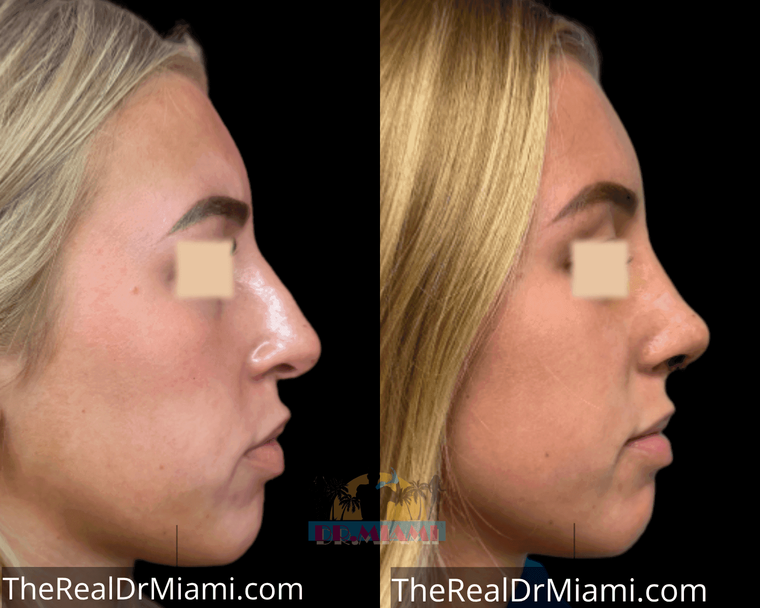 Before-and-after views for Rhinoplasty, Case 25.