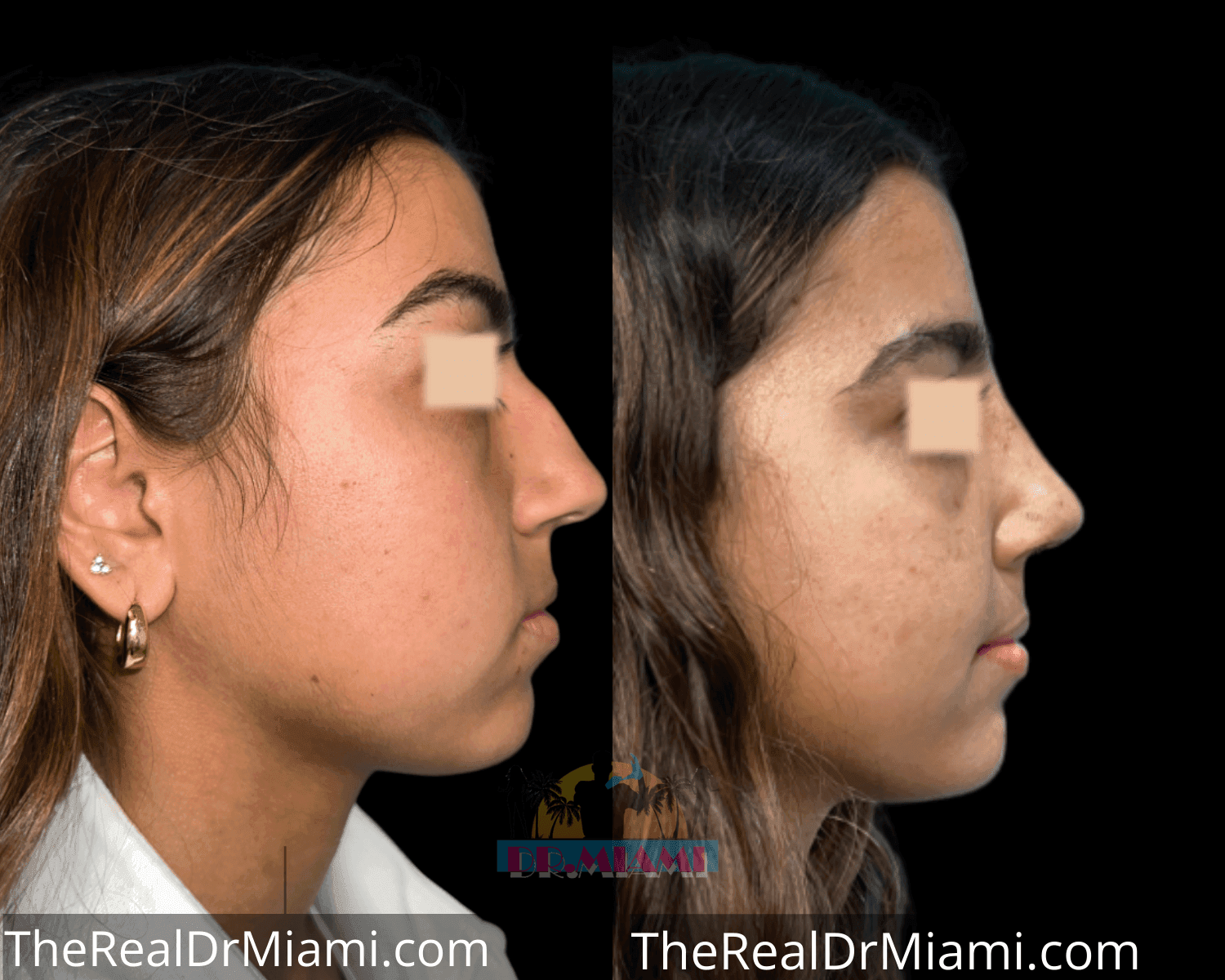 Before-and-after views for Rhinoplasty, Case 57.
