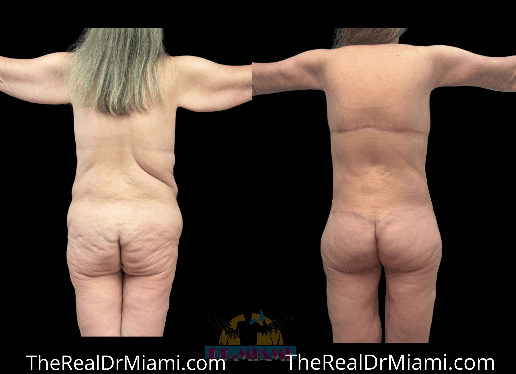 Before-and-after views for Massive Weight Loss, Case 29.